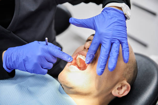 Best Knocked-Out Tooth (Avulsed Tooth) Treatment in Folsom, NJ