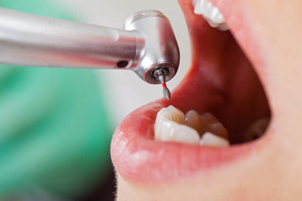 Best Broken or Chipped Tooth Repair in Folsom, NJ
